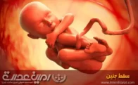 سقط جنین